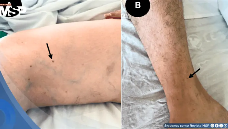 Trombocitopenia severa tras vacuna contra t&eacute;tanos y difteria en mujer con amputaci&oacute;n parcial de falange