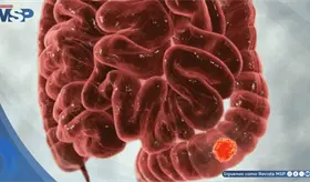 S&iacute;ntomas digestivos que parecen colon irritable podr&iacute;an ser c&aacute;ncer colorrectal &iquest;C&oacute;mo diferenciarlos?