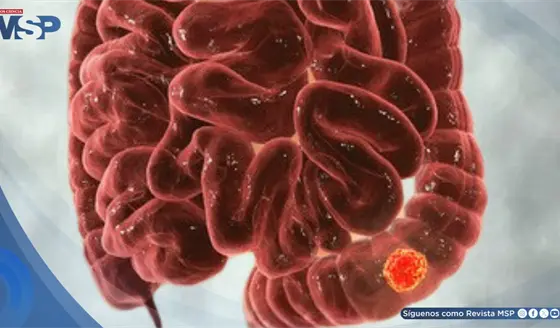 S&iacute;ntomas digestivos que parecen colon irritable podr&iacute;an ser c&aacute;ncer colorrectal &iquest;C&oacute;mo diferenciarlos?