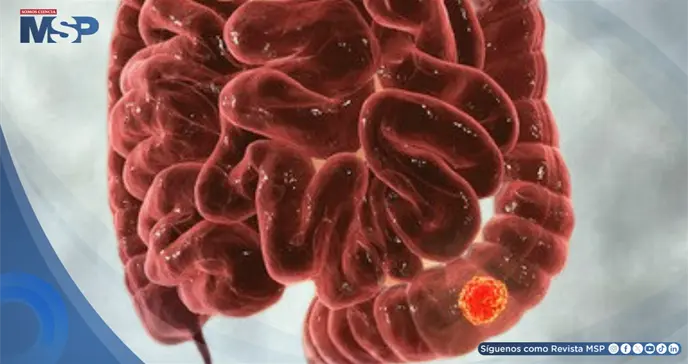 Síntomas digestivos que parecen colon irritable podrían ser cáncer colorrectal ¿Cómo diferenciarlos?