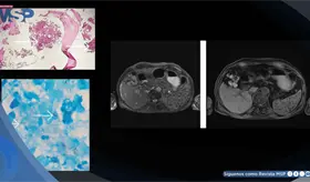 Tuberculosis extrapulmonar infiltr&oacute; la m&eacute;dula &oacute;sea y provoc&oacute; pancitopenia severa en adulto mayor