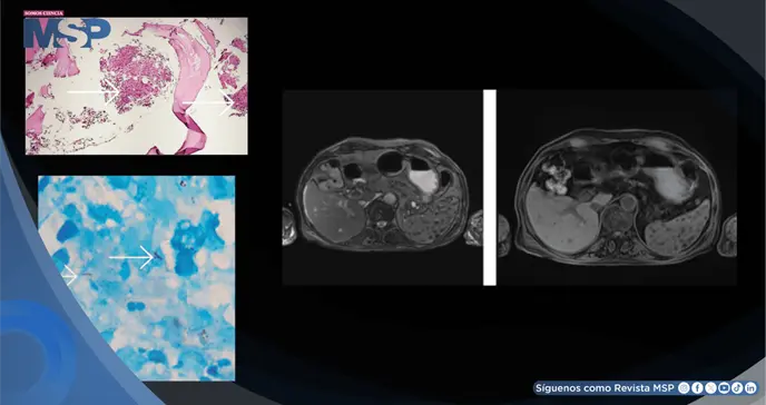 Tuberculosis extrapulmonar infiltró la médula ósea y provocó pancitopenia severa en adulto mayor Tuberculosis extrapulmonar infiltró la médula ósea y provocó pancitopenia severa en adulto mayor