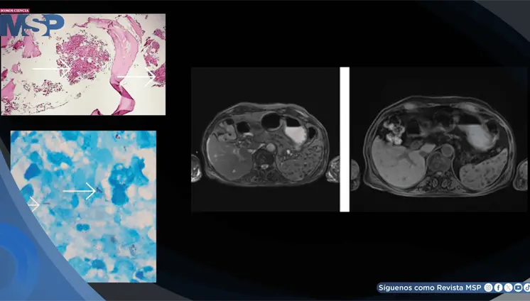 Tuberculosis extrapulmonar infiltró la médula ósea y provocó pancitopenia severa en adulto mayor Tuberculosis extrapulmonar infiltró la médula ósea y provocó pancitopenia severa en adulto mayor