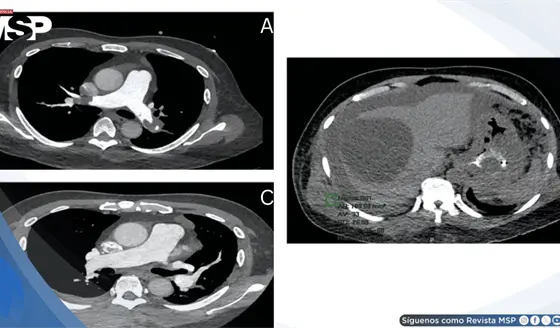 Embolia pulmonar en silla de montar asociada a f&aacute;rmaco en paciente con enfermedad renal y c&aacute;ncer g&aacute;strico