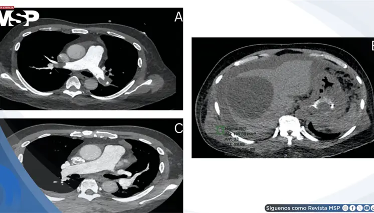 Embolia pulmonar en silla de montar asociada a f&aacute;rmaco en paciente con enfermedad renal y c&aacute;ncer g&aacute;strico