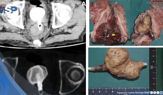 C&aacute;lculo vesical gigante adherido a cuerpo extra&ntilde;o rectal desencaden&oacute; sepsis fatal en paciente de 60 a&ntilde;os