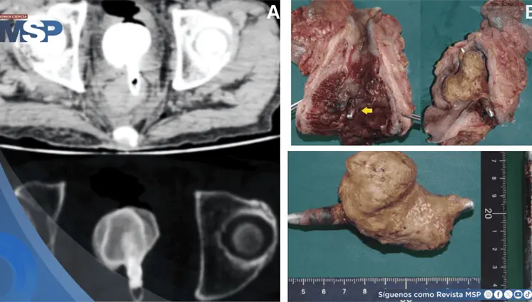 C&aacute;lculo vesical gigante adherido a cuerpo extra&ntilde;o rectal desencaden&oacute; sepsis fatal en paciente de 60 a&ntilde;os
