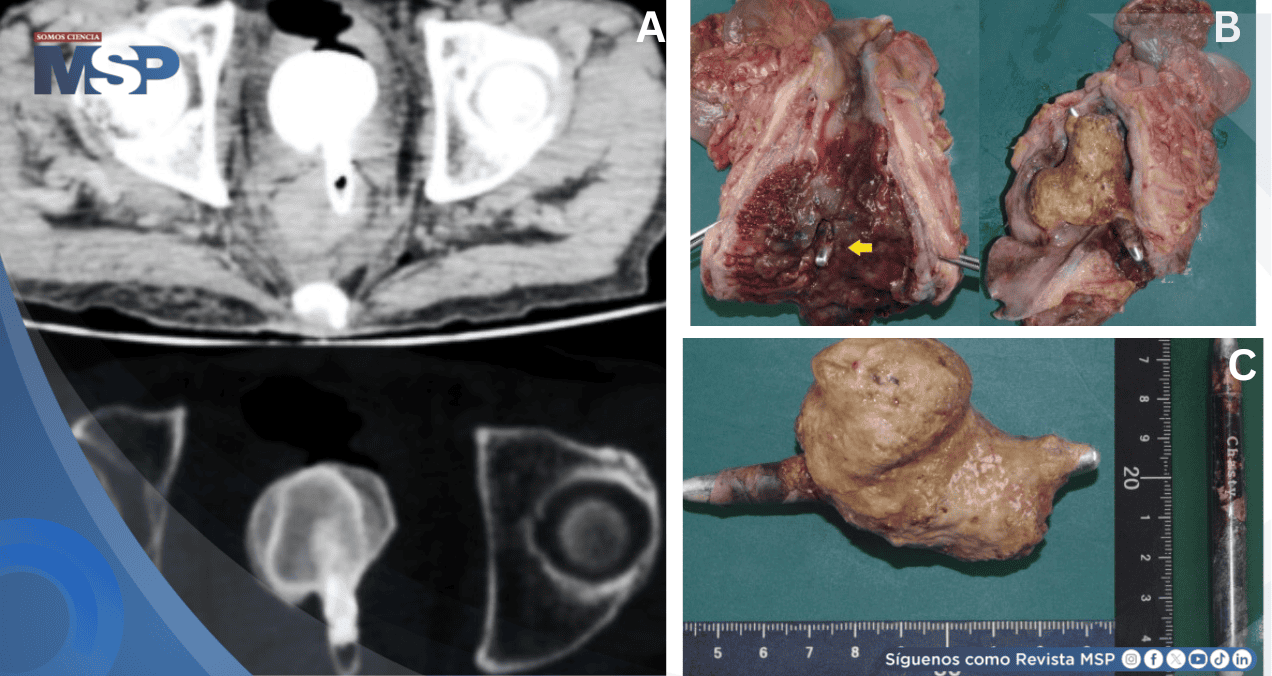 Cálculo vesical gigante adherido a cuerpo extraño rectal desencadenó sepsis fatal en paciente de 60 años
