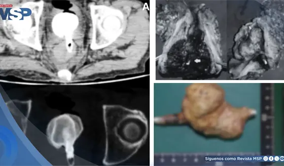 C&aacute;lculo vesical gigante adherido a cuerpo extra&ntilde;o rectal desencaden&oacute; sepsis fatal en paciente de 60 a&ntilde;os