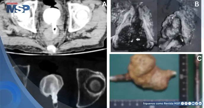 C&aacute;lculo vesical gigante adherido a cuerpo extra&ntilde;o rectal desencaden&oacute; sepsis fatal en paciente de 60 a&ntilde;os