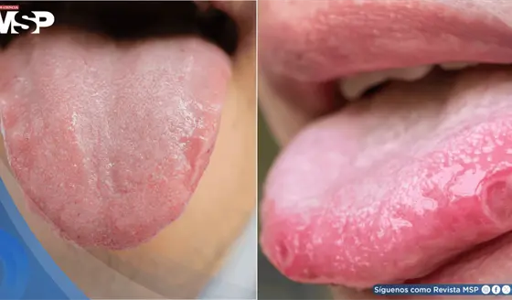 &iquest;Lengua p&aacute;lida, lisa o con &uacute;lceras? Se&ntilde;ales que pueden alertar sobre problemas de salud