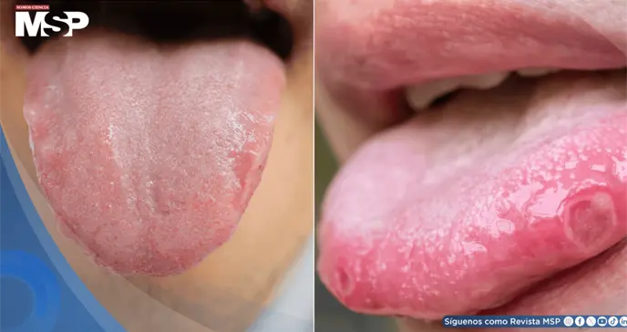 &iquest;Lengua p&aacute;lida, lisa o con &uacute;lceras? Se&ntilde;ales que pueden alertar sobre problemas de salud