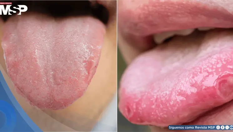 ¿Lengua pálida, lisa o con úlceras? Señales que pueden alertar sobre problemas de salud ¿Lengua pálida, lisa o con úlceras? Señales que pueden alertar sobre problemas de salud