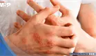 &iquest;Picaz&oacute;n persistente y piel seca? Esto es lo que dicen las nuevas gu&iacute;as de dermatitis at&oacute;pica 