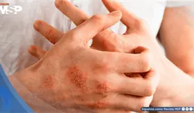 ¿Picazón persistente y piel seca? Esto es lo que dicen las nuevas guías de dermatitis atópica