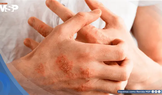 &iquest;Picaz&oacute;n persistente y piel seca? Esto es lo que dicen las nuevas gu&iacute;as de dermatitis at&oacute;pica 