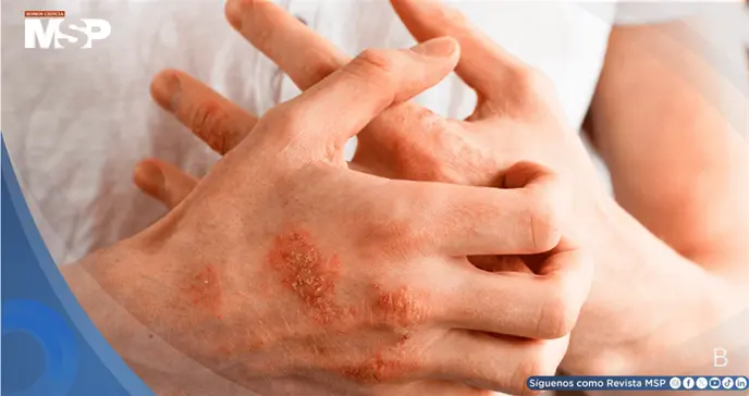 &iquest;Picaz&oacute;n persistente y piel seca? Esto es lo que dicen las nuevas gu&iacute;as de dermatitis at&oacute;pica 