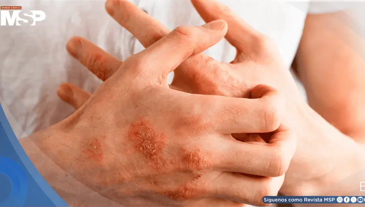 ¿Picazón persistente y piel seca? Esto es lo que dicen las nuevas guías de dermatitis atópica ¿Picazón persistente y piel seca? Esto es lo que dicen las nuevas guías de dermatitis atópica