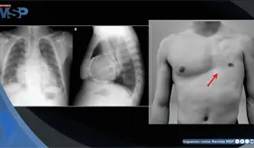 Dolor torácico y derrame pericárdico en hombre sin músculos pectorales causado por pericarditis aguda