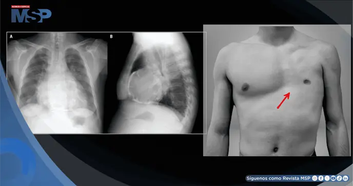 Dolor torácico y derrame pericárdico en hombre sin músculos pectorales causado por pericarditis aguda Dolor torácico y derrame pericárdico en hombre sin músculos pectorales causado por pericarditis aguda
