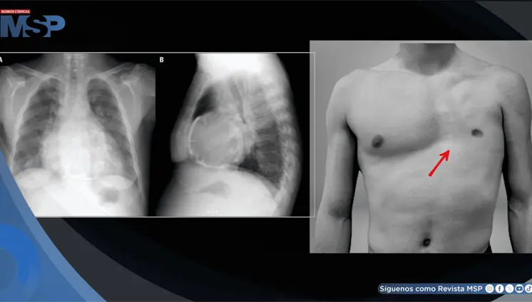 Dolor torácico y derrame pericárdico en hombre sin músculos pectorales causado por pericarditis aguda Dolor torácico y derrame pericárdico en hombre sin músculos pectorales causado por pericarditis aguda