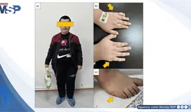 Primer trasplante renal de donante vivo en paciente con Síndrome de Bardet-Biedl