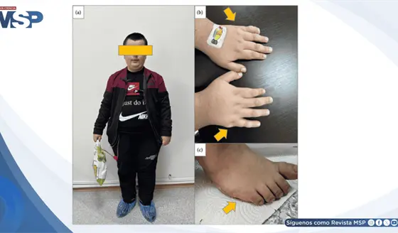 Primer trasplante renal de donante vivo en paciente con S&iacute;ndrome de Bardet-Biedl 