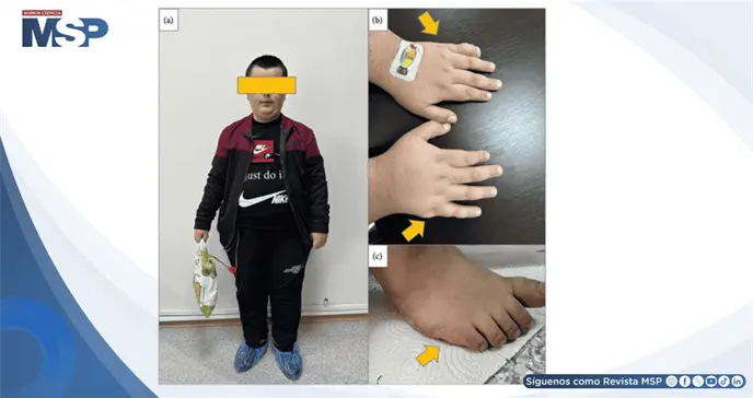 Primer trasplante renal de donante vivo en paciente con S&iacute;ndrome de Bardet-Biedl 