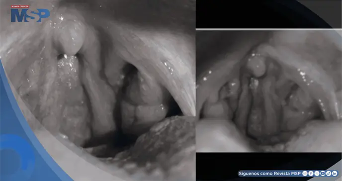 Faringitis bacteriana recurrente en mujer gestante requiri&oacute; manejo alternativo ante alergia a penicilina