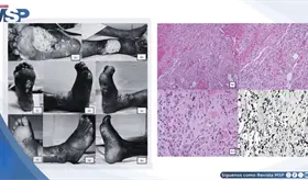 Sarcoma de Kaposi se presentó como edema crónico de pierna y fue confundido con dermatitis de estasis