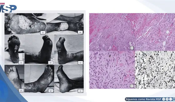 Sarcoma de Kaposi se present&oacute; como edema cr&oacute;nico de pierna y fue confundido con dermatitis de estasis 