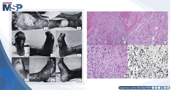 Sarcoma de Kaposi se present&oacute; como edema cr&oacute;nico de pierna y fue confundido con dermatitis de estasis 