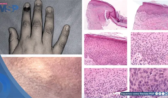 C&aacute;ncer de piel en menor de 11 a&ntilde;os fue detectado por una mancha asintom&aacute;tica alrededor de la u&ntilde;a