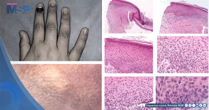 C&aacute;ncer de piel en menor de 11 a&ntilde;os fue detectado por una mancha asintom&aacute;tica alrededor de la u&ntilde;a