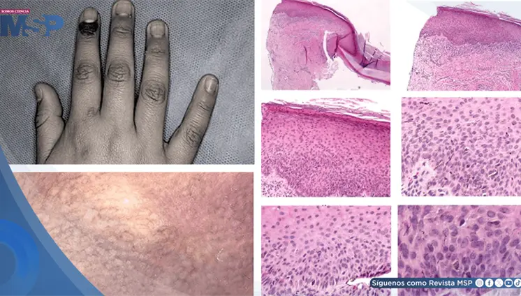 Cáncer de piel en menor de 11 años fue detectado por una mancha asintomática alrededor de la uña Cáncer de piel en menor de 11 años fue detectado por una mancha asintomática alrededor de la uña