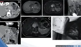 Cefaleas, palpitaciones e hipertensión severa revelan paraganglioma funcional portocava de 7,2 cm