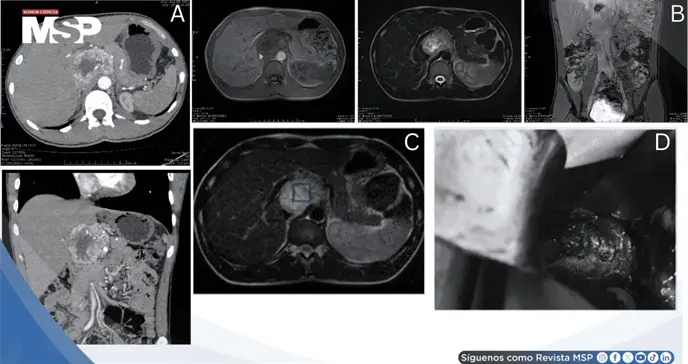 Cefaleas, palpitaciones e hipertensión severa revelan paraganglioma funcional portocava de 7,2 cm Cefaleas, palpitaciones e hipertensión severa revelan paraganglioma funcional portocava de 7,2 cm