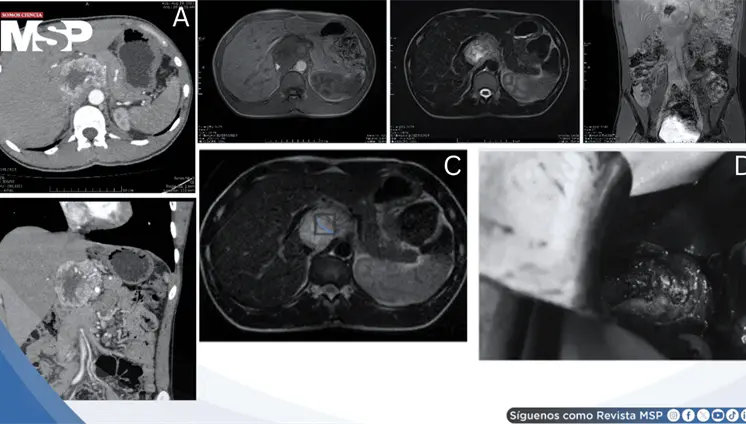Cefaleas, palpitaciones e hipertensión severa revelan paraganglioma funcional portocava de 7,2 cm Cefaleas, palpitaciones e hipertensión severa revelan paraganglioma funcional portocava de 7,2 cm