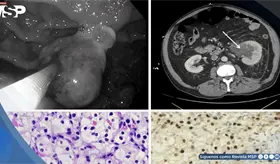 Metástasis gástrica permitió detectar cáncer en el riñón en paciente de 65 años con fibrilación auricular