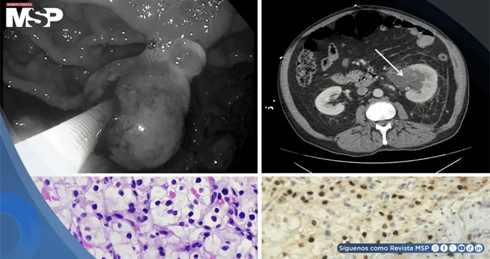 Metástasis gástrica permitió detectar cáncer en el riñón en paciente de 65 años con fibrilación auricular Metástasis gástrica permitió detectar cáncer en el riñón en paciente de 65 años con fibrilación auricular