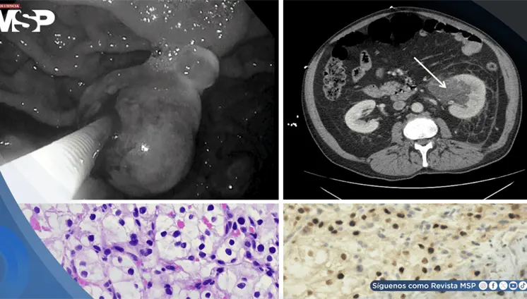 Metástasis gástrica permitió detectar cáncer en el riñón en paciente de 65 años con fibrilación auricular Metástasis gástrica permitió detectar cáncer en el riñón en paciente de 65 años con fibrilación auricular