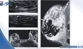 Galactorrea, secreción mamaria y aumento de prolactina generado por efecto adverso de metoclopramida