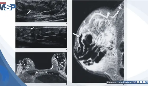 Galactorrea, secreci&oacute;n mamaria y aumento de prolactina generado por efecto adverso de metoclopramida