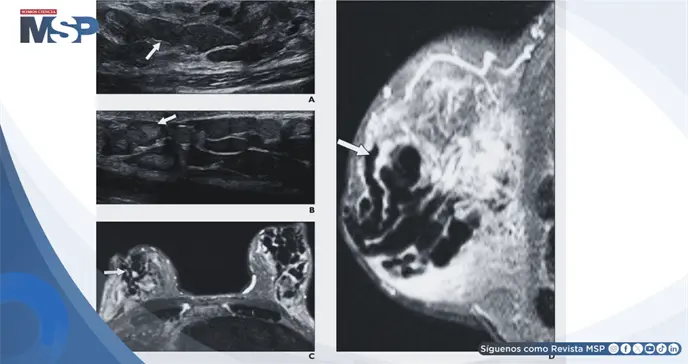 Galactorrea, secreción mamaria y aumento de prolactina generado por efecto adverso de metoclopramida Galactorrea, secreción mamaria y aumento de prolactina generado por efecto adverso de metoclopramida