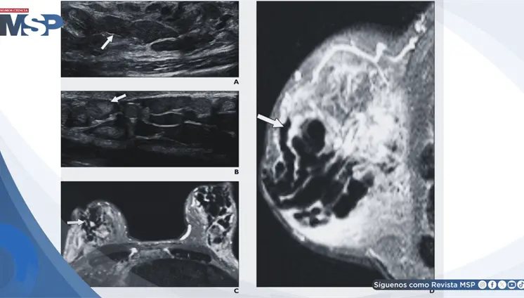 Galactorrea, secreción mamaria y aumento de prolactina generado por efecto adverso de metoclopramida Galactorrea, secreción mamaria y aumento de prolactina generado por efecto adverso de metoclopramida