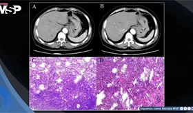 Melanoma gástrico primario en mujer de 71 años con distensión abdominal y anorexia