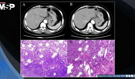 Melanoma g&aacute;strico primario en mujer de 71 a&ntilde;os con distensi&oacute;n abdominal y anorexia