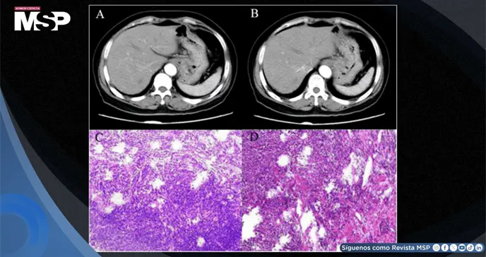 Melanoma g&aacute;strico primario en mujer de 71 a&ntilde;os con distensi&oacute;n abdominal y anorexia