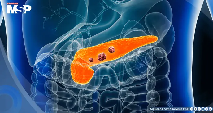 Científicos lograrían eliminar tumores pancreáticos en modelos animales evitando resistencias: Estudio Científicos lograrían eliminar tumores pancreáticos en modelos animales evitando resistencias: Estudio