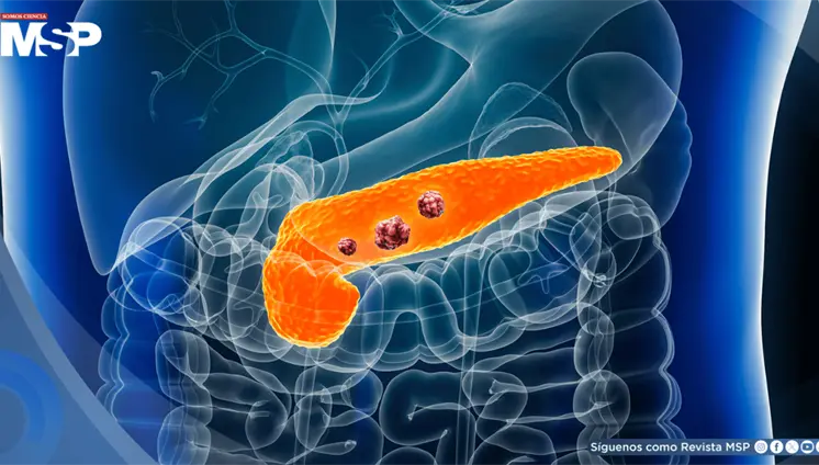 Científicos lograrían eliminar tumores pancreáticos en modelos animales evitando resistencias: Estudio Científicos lograrían eliminar tumores pancreáticos en modelos animales evitando resistencias: Estudio